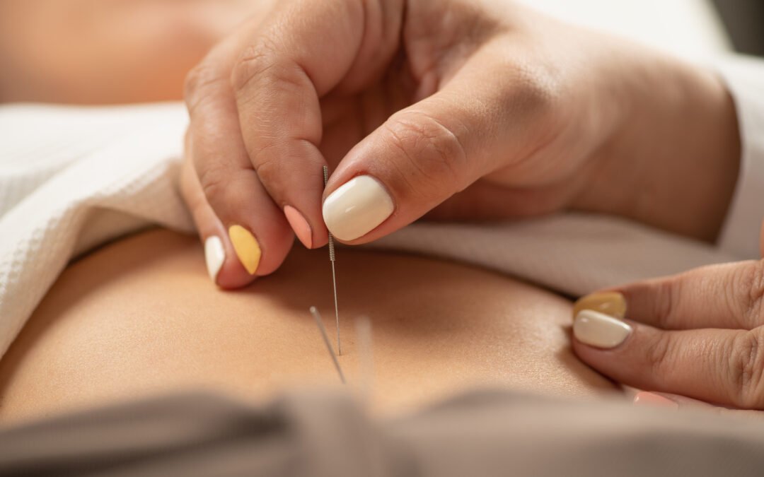 Experience Healing Through Adele Community Acupuncture: A Path to Wellness